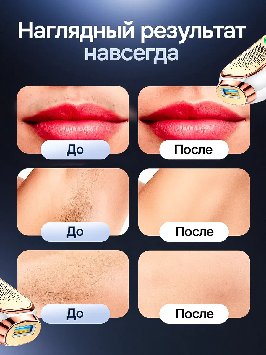 Фотоэпилятор лазерный для удаления волос на теле и лице — фото 4